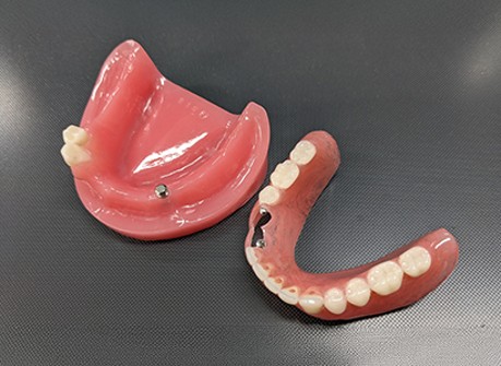 高品質なノンクラスプデンチャー